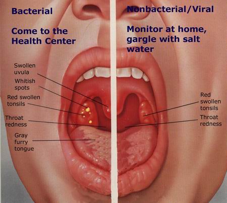 Swollen Tonsils In Adults 11